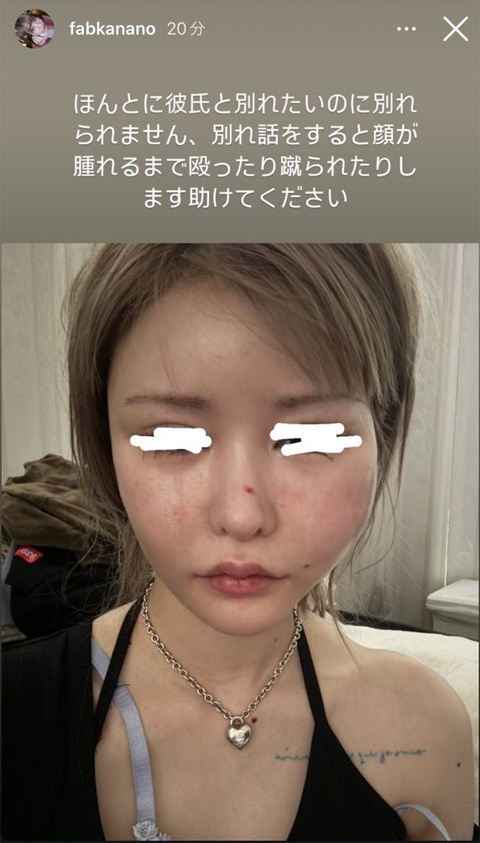 戦慄かなの 腫れ上がった顔